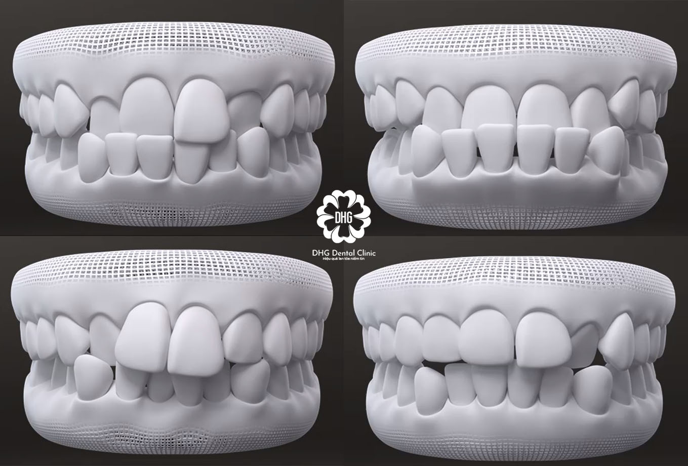 Niềng răng Invisalign phù hợp cho nhiều trường hợp răng